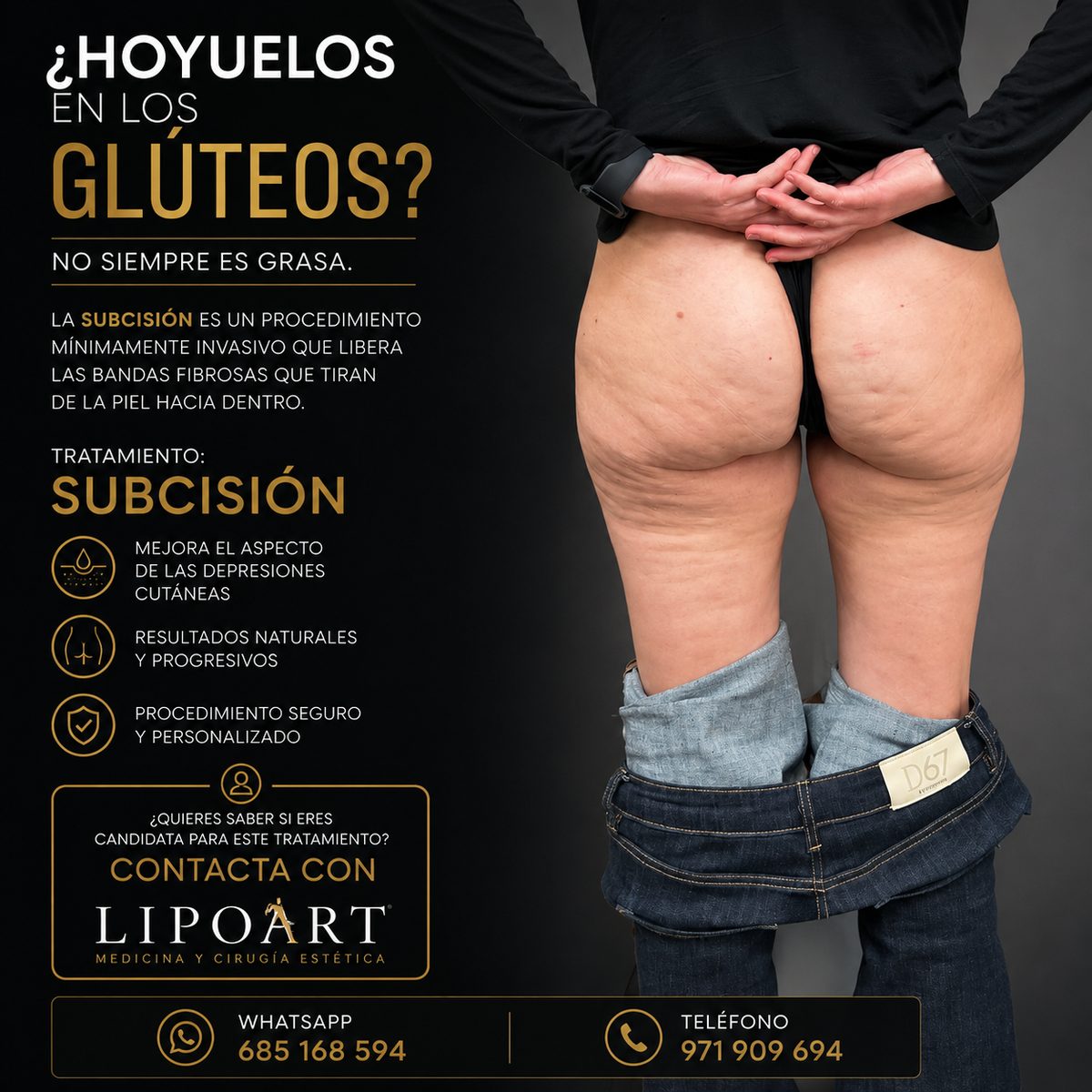 Subcisión para tratar hoyuelos y celulitis en glúteos antes del tratamiento en LIPOART Mallorca